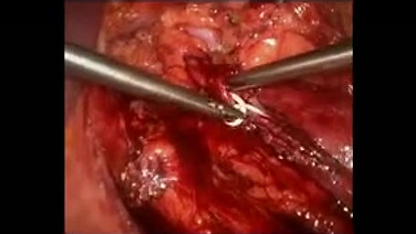 Laparoscopic Ureteric Stricture Repair